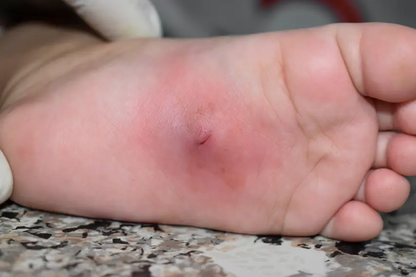 Infection Signs